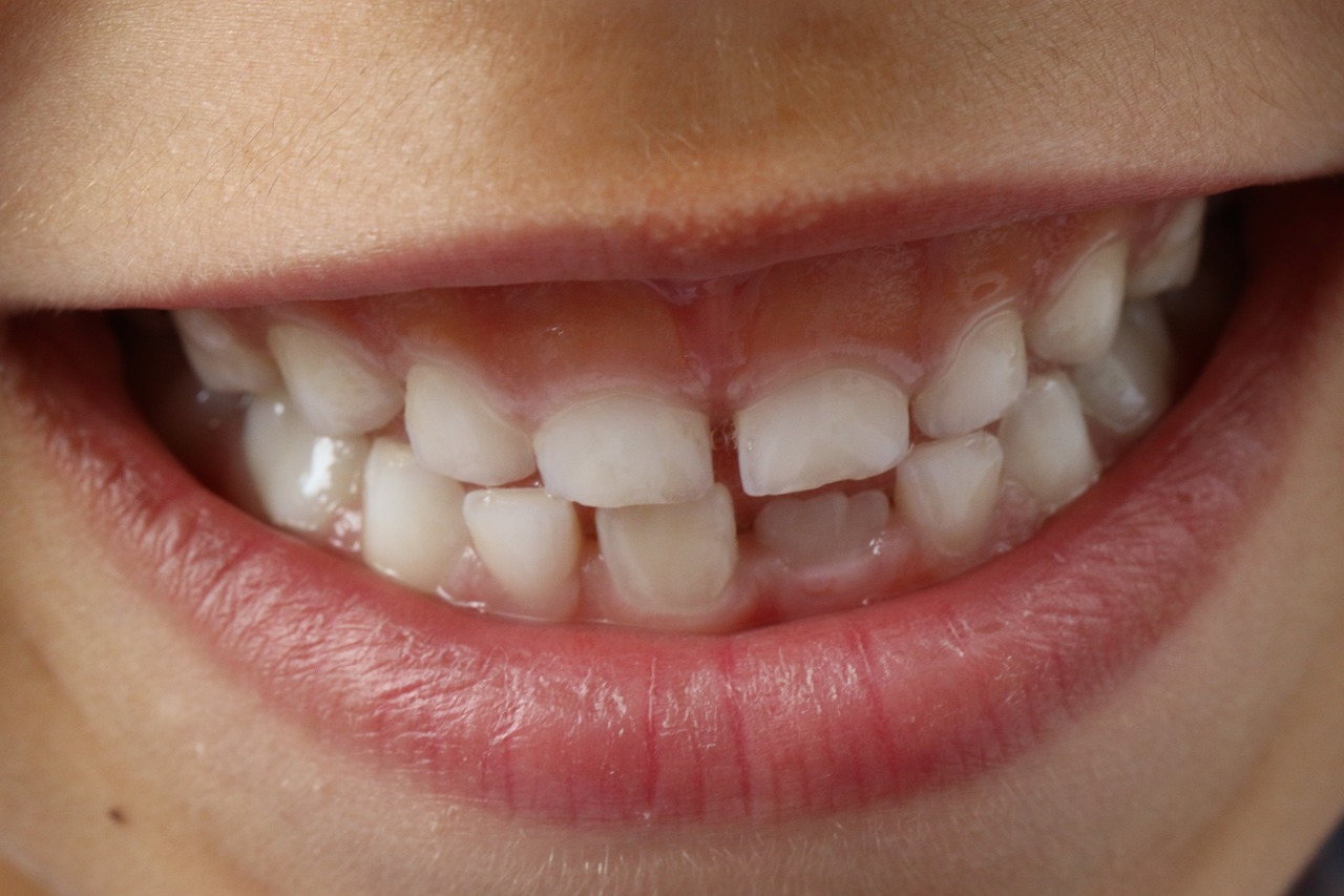 İnvisalign vs. Lingual Braketler
