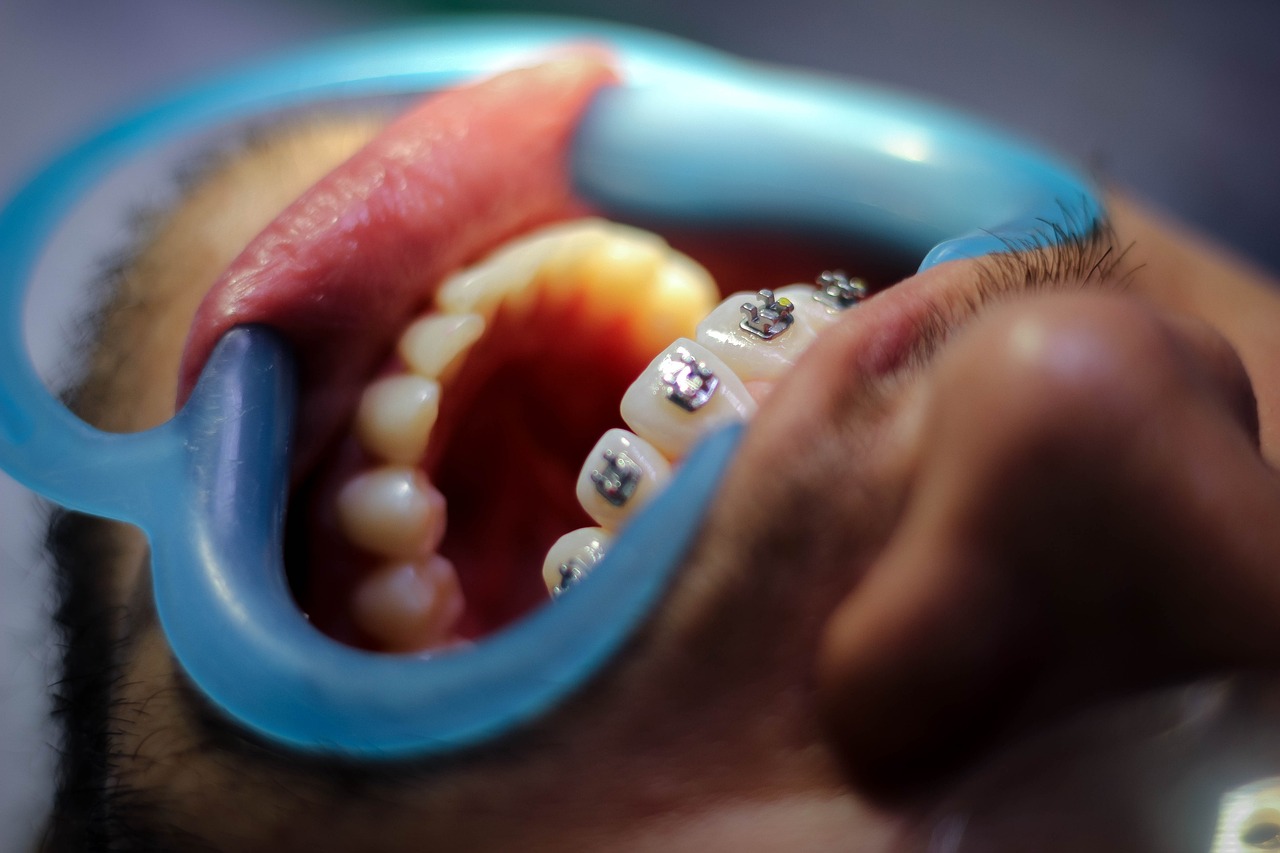 İnvisalign Plaklarının Günlük Bakımı: Temizlik ve Bakım İçin İpuçları