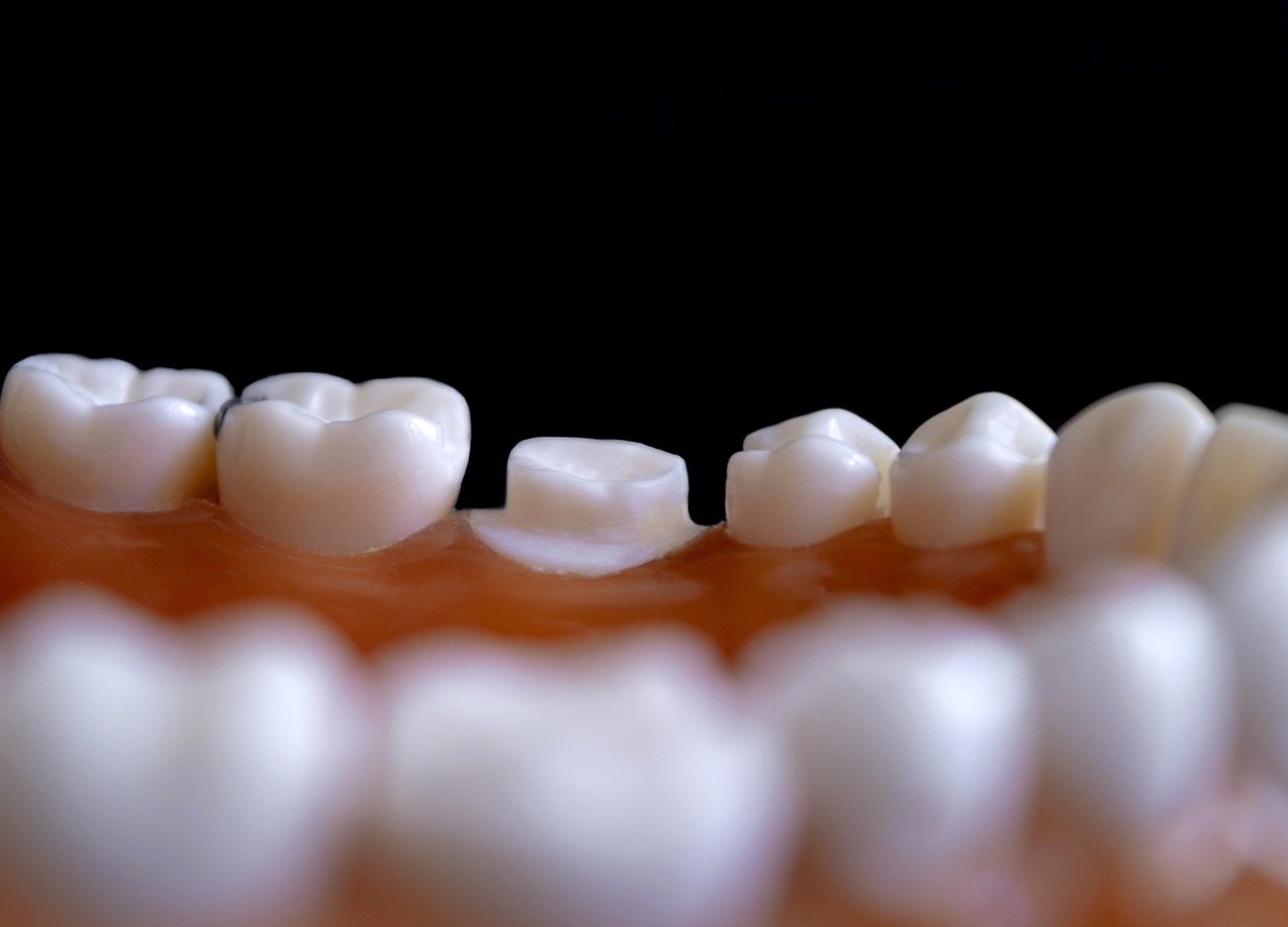 İnvisalign Plaklarının Yemek Sırasında Rahatsızlık Vermesi: Ne Yapmalısınız?