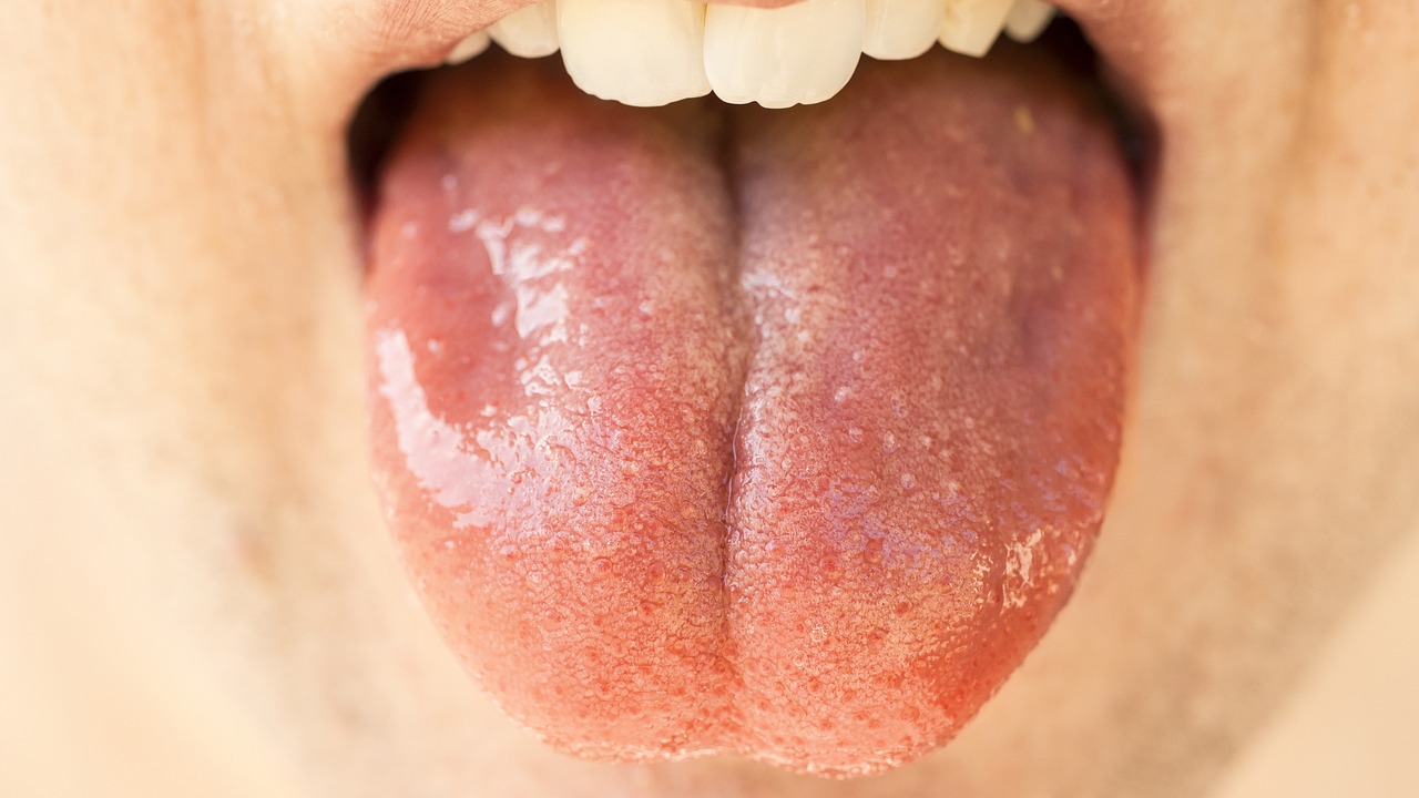 İnvisalign Plaklarında Tükürük Artışı