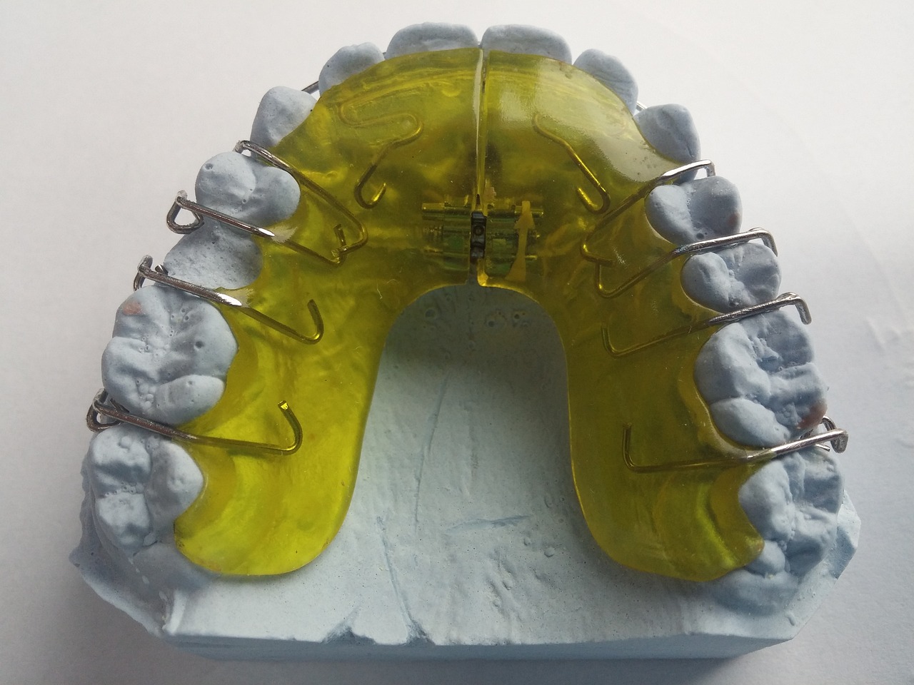 Invisalign Tedavisiyle Elde Edilen Sonuçları Paylaşan Hasta Hikayeleri