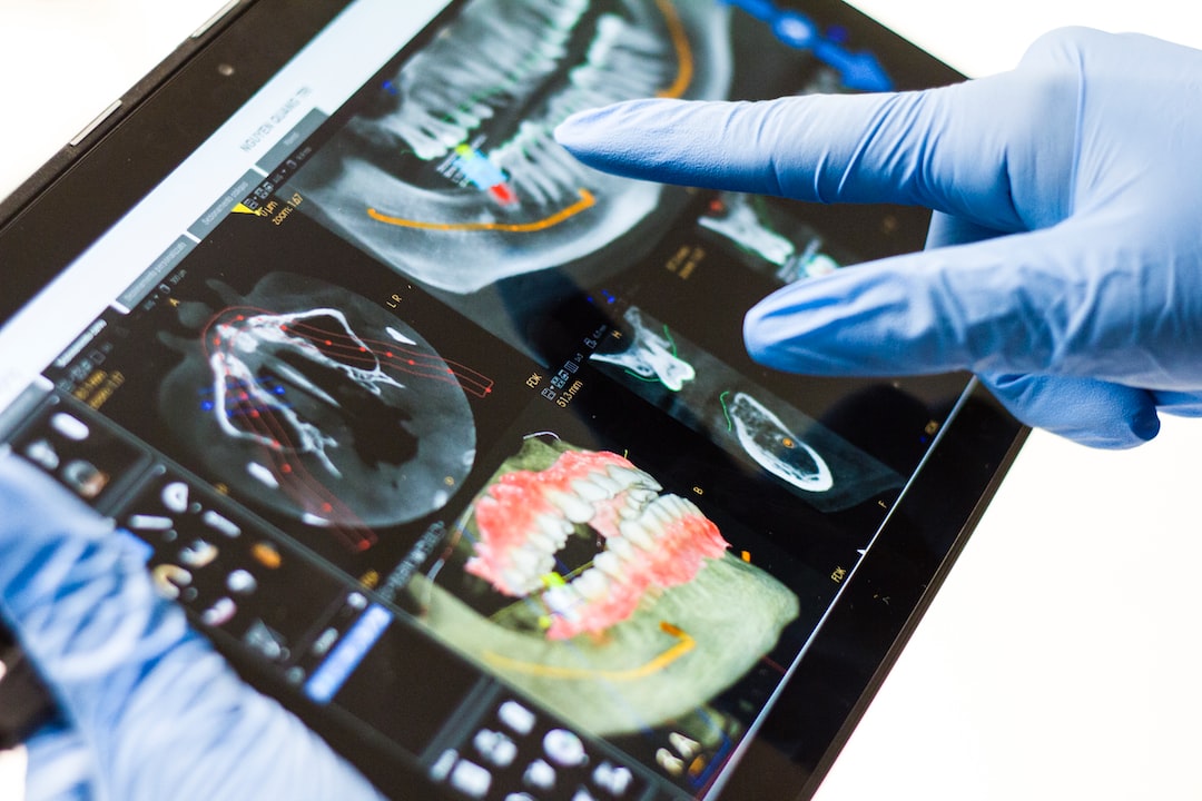 İnvisalign Tedavisinde İlk Plakları Alma 
